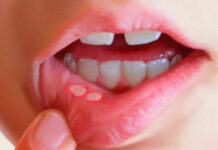 Afta na boca: Jamais coloque Bicarbonato de sódio para curar aftas