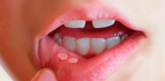 Afta na boca: Jamais coloque Bicarbonato de sódio para curar aftas