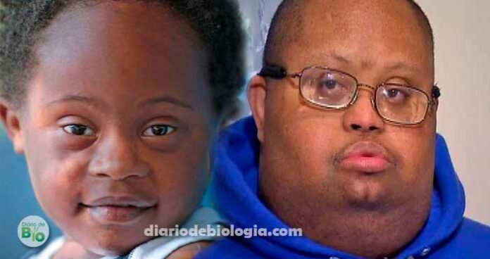 Síndrome de Down: É verdade que a doença não acontece em pessoas negras?