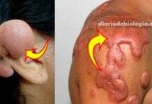 Como tirar queloide na orelha e outras partes do corpo