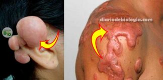 Como tirar queloide na orelha e outras partes do corpo