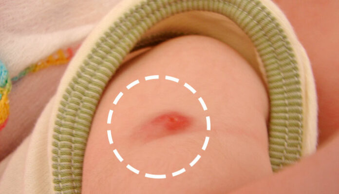 Vacina BCG: Por que fica inflamada e deixa cicatriz? Ela causa febre?