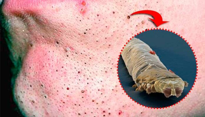 É verdade que os cravos na nossa pele são aracnídeos? Veja o vídeo