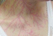 tatuagem causada por um raio