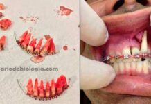 Aparelho ortodôntico caseiro: o perigo do aparelho dental feito em casa