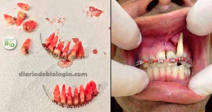 Aparelho ortodôntico caseiro: o perigo do aparelho dental feito em casa