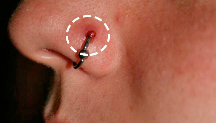 Piercing: além do queloide, o Granuloma Piogênico pode ser um problema