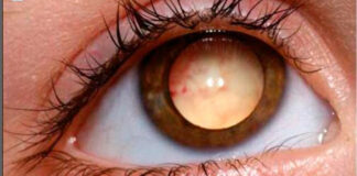 Câncer na retina: flash fotográfico pode identificar retinoblastoma