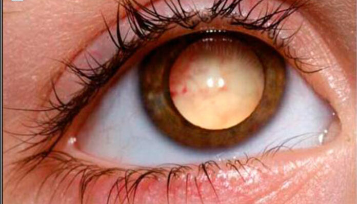 Câncer na retina: flash fotográfico pode identificar retinoblastoma