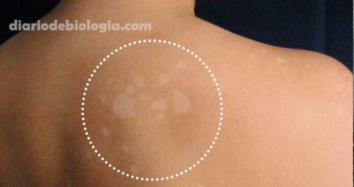 Pano branco na pele: especialista explica as manchas brancas na pele