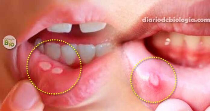 Como curar afta na boca: Aprenda remédios caseiros