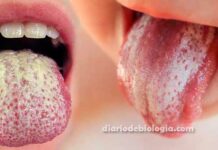 Manchas brancas na boca: pode ser candidíase bucal (sapinho)