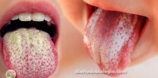Manchas brancas na boca: pode ser candidíase bucal (sapinho)