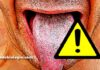 Língua branca: Quais as doenças que causam mancha branca na língua?