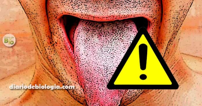Língua branca: Quais as doenças que causam mancha branca na língua?