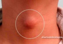 Caroço no pescoço, axila e virilha, pode ser linfoma