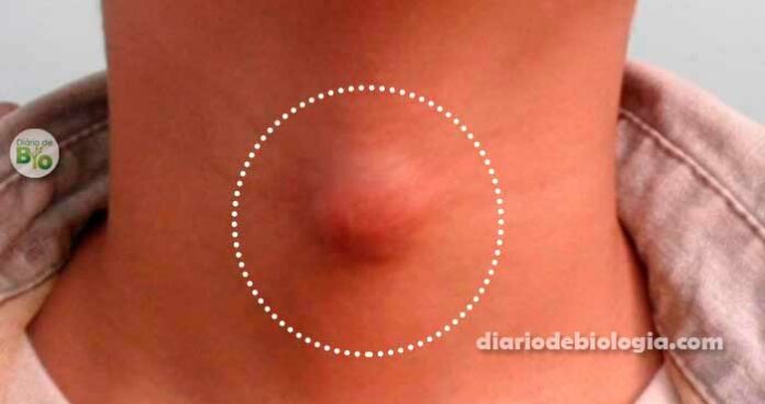 Caroço no pescoço, axila e virilha, pode ser linfoma