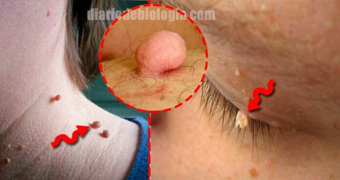 Verruga mole ou Fibroma mole, veja o que fazer para se livrar