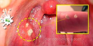 Cáseos amigdalianos, bolinha branca na garganta que causam mau hálito