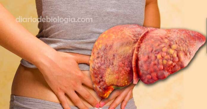 Sintomas de gordura no fígado: Veja se seu problema é esteatose