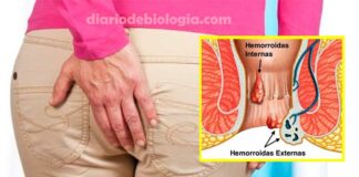 Sintomas de hemorroida: como identificar antes de ir ao médico