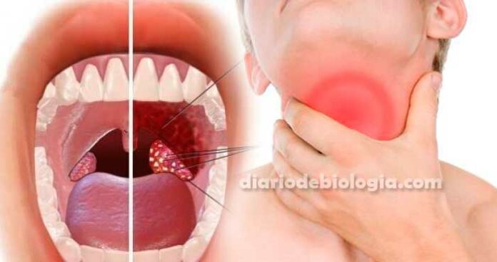curar abscesso na garganta