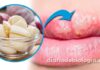 Tratamento para herpes labial: médico ensina remédio caseiro com alho pode curar herpes em um dia