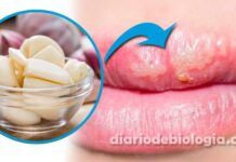 Tratamento para herpes labial: médico ensina remédio caseiro com alho pode curar herpes em um dia
