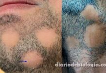 Barba falhada: perda de cabelo na barba pode ser alopecia areata