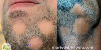 Barba falhada: perda de cabelo na barba pode ser alopecia areata