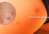 Bolinhas no bumbum (foliculite): Jamais esprema! Veja as causas e o que fazer