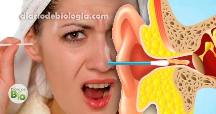 Cotonetes podem perfurar o tímpano e deslocar os ossos do ouvido