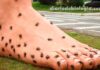 Tudo sobre PAF: Polineuropatia Amiloidótica Familiar - a Doença do pé gigante