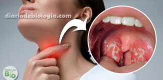 Aprenda a diferenciar a dor de garganta viral da bacteriana
