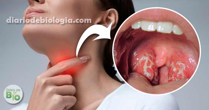 Infecção ou inflamação na garganta: qual a diferença - Ötri