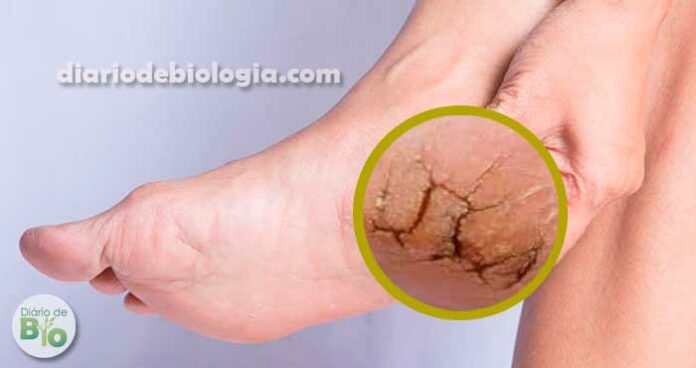 pés ressecados dermatologista explica o que pode estar causando esse problema