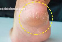 Como tratar Rachadura nos pés tratamentos com base em estudos científicos