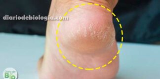 Como tratar Rachadura nos pés tratamentos com base em estudos científicos
