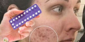 Melhor anticoncepcional para acne (espinha) inflamada e infeccionada