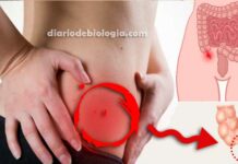 Sintomas de apendicite dor na barriga