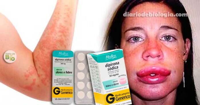 Alergia a Dipirona: Veja os sintomas e quais remédios não pode tomar