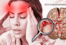 Sintomas de Aneurisma Cerebral