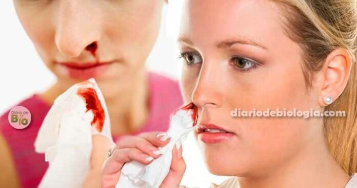 Nariz sangrando (sangramento nasal): o que fazer quando o nariz sangra?