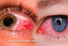 Olhos vermelhos e irritados: O que pode ser? Quando ir ao hospital?