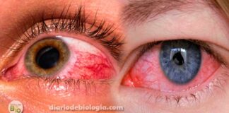 Olhos vermelhos e irritados: O que pode ser? Quando ir ao hospital?