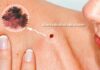 Câncer de pele: Como saber identificar melanoma?