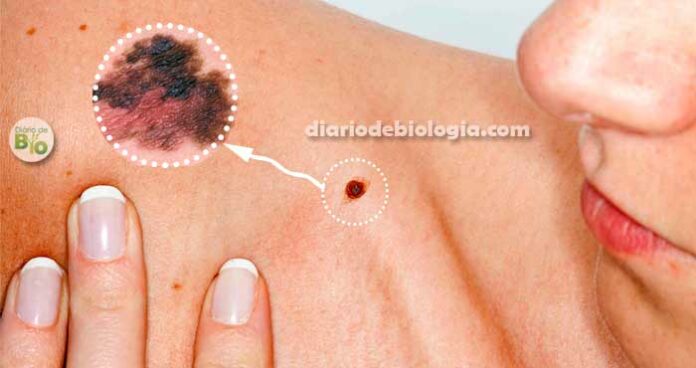 Câncer de pele: Como saber identificar melanoma?