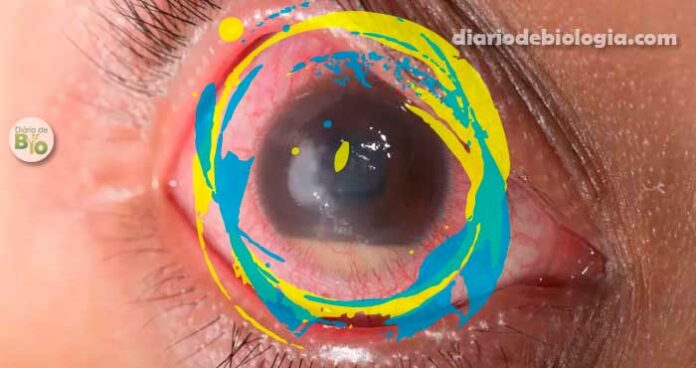 Como saber se tenho glaucoma? Sinais e sintomas da doença