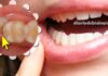 Dente do siso: Como aliviar a dor de dente siso? Dentista ensina