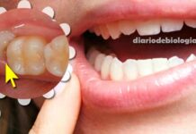 Dente do siso: Como aliviar a dor de dente siso? Dentista ensina